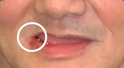 植體周圍炎造成骨頭萎縮