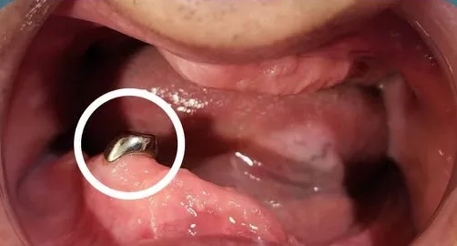 口內無法使用的植體